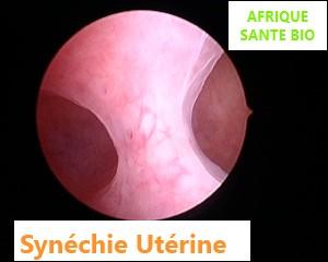 Synechie uterine synéchie de l'utérus, Traitement naturel synéchie