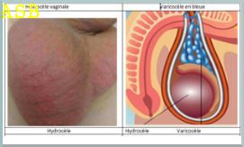 T 74 varicocele