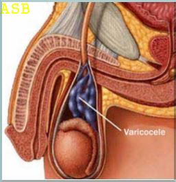 T 75 varicocele