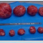 Tailles fibromes traitement