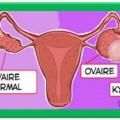 Traitement kyste ovarien:Rose de Jéricho Bienfaits