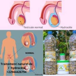 Traitement naturel de l hydrocele 22944426794 320x320