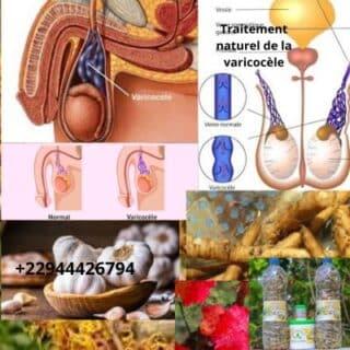 Comment soigner la varicocèle et devenir très fécond?