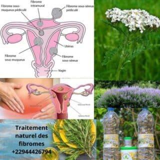 Comment soigner les fibromes, myomes? Remède naturel
