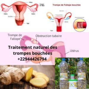 Déboucher les trompes au Cameroun? Traitement naturel