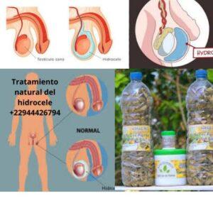 Tratamiento natural del hidrocele 22944426794 300x300