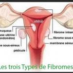 Trois types fibromes, Se débarrasser de fibrome naturellement