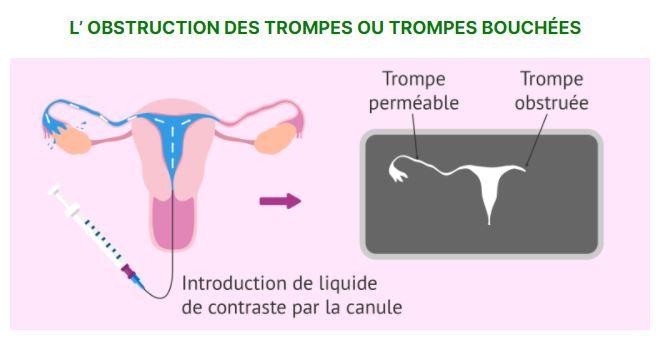 Trompes bouchées traitement Naturel