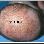 Une dermite