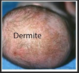 Une dermite