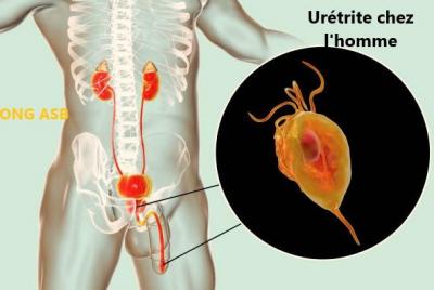 Uretrite chez l homme