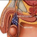Varice testicules , Meilleur Remède naturel Varicocèle