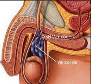 Varice testicules , Meilleur Remède naturel Varicocèle