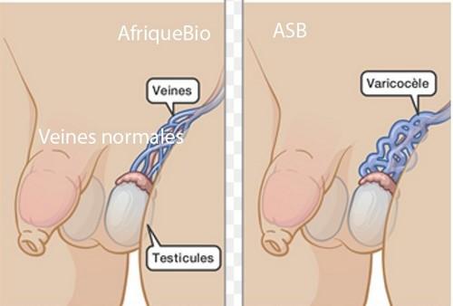 Varicocèle, Varice aux testicules, Meilleur Remède Naturel