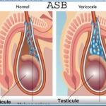 Varicocele traitement 1