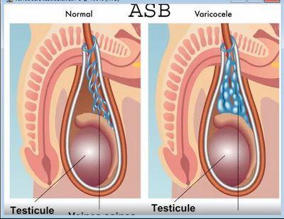 Varicocele traitement 1