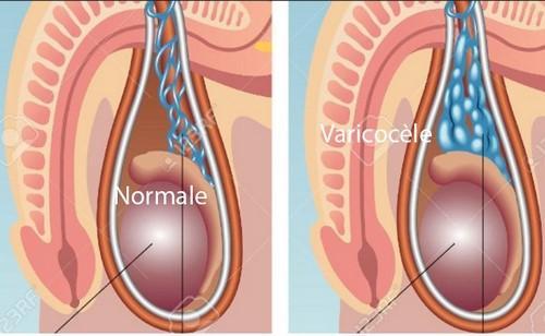 Varicocèle varice des testicules, Plantes Soigner Varicocèle