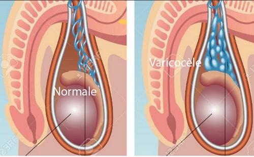 Varicocèle varice des testicules Traitement